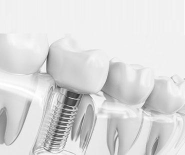 Diş İmplantı Nedir, Nasıl Tedavi Edilir?