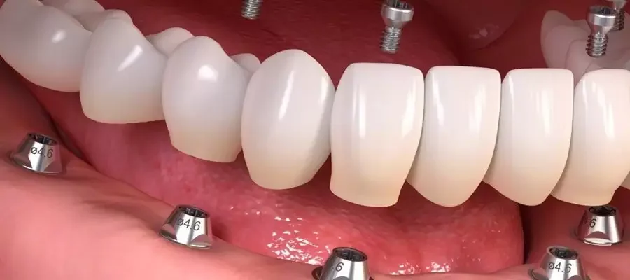 Diş İmplantı Nedir, Nasıl Yapılır ve Kimlere Uygundur?